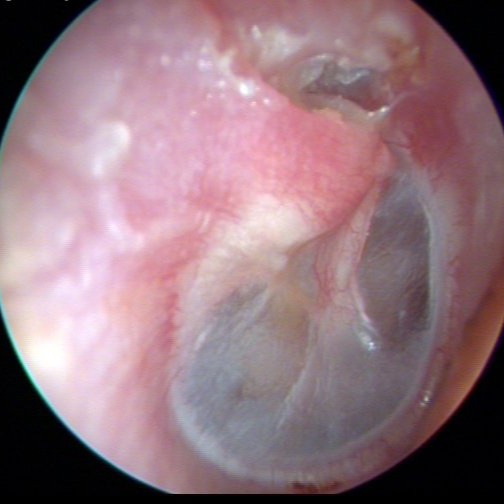 Cholesteatoma Stage 1