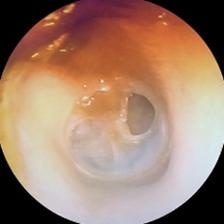 Cholesteatoma Stage 2