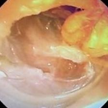 Cholesteatoma Stage 3
