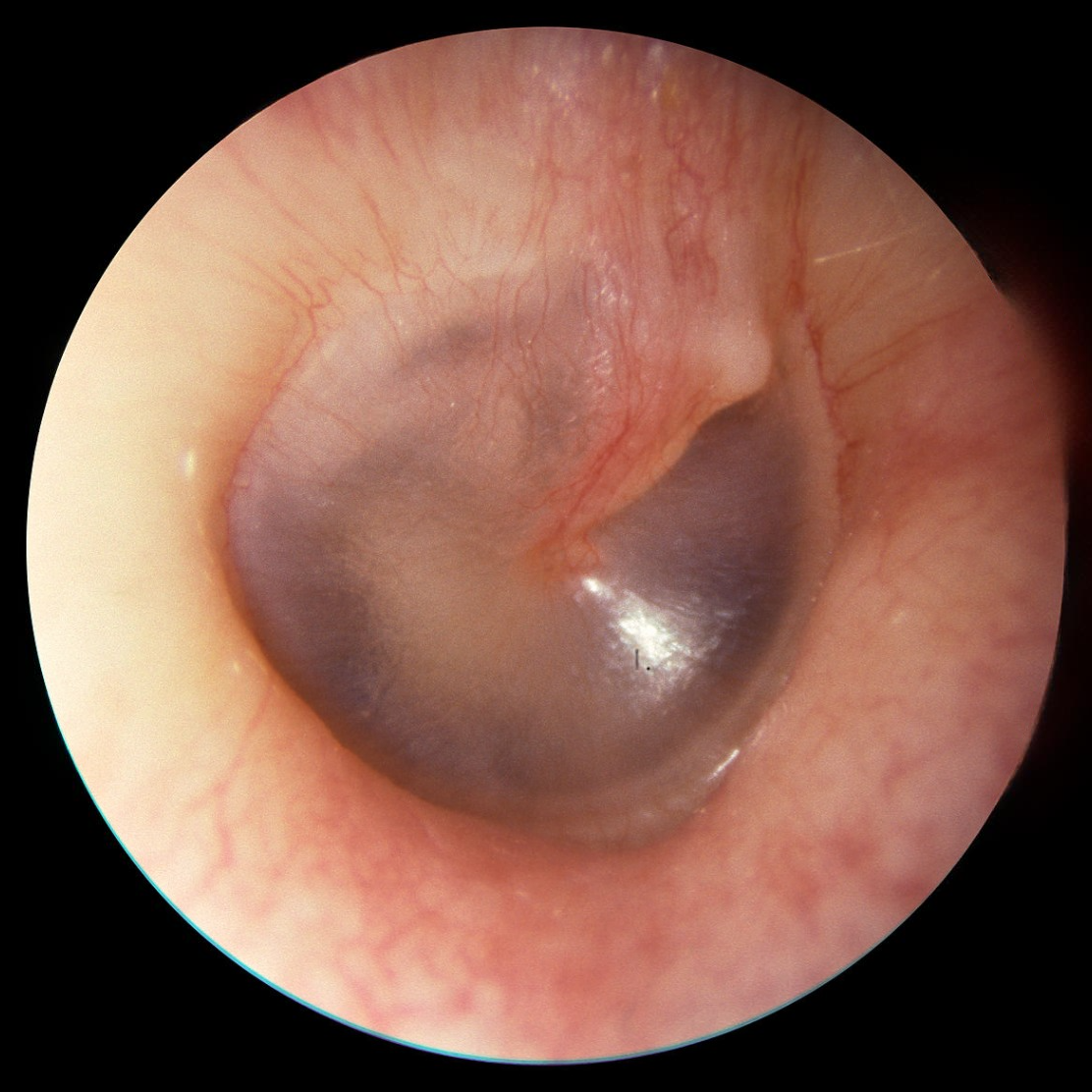 Cholesteatoma Image