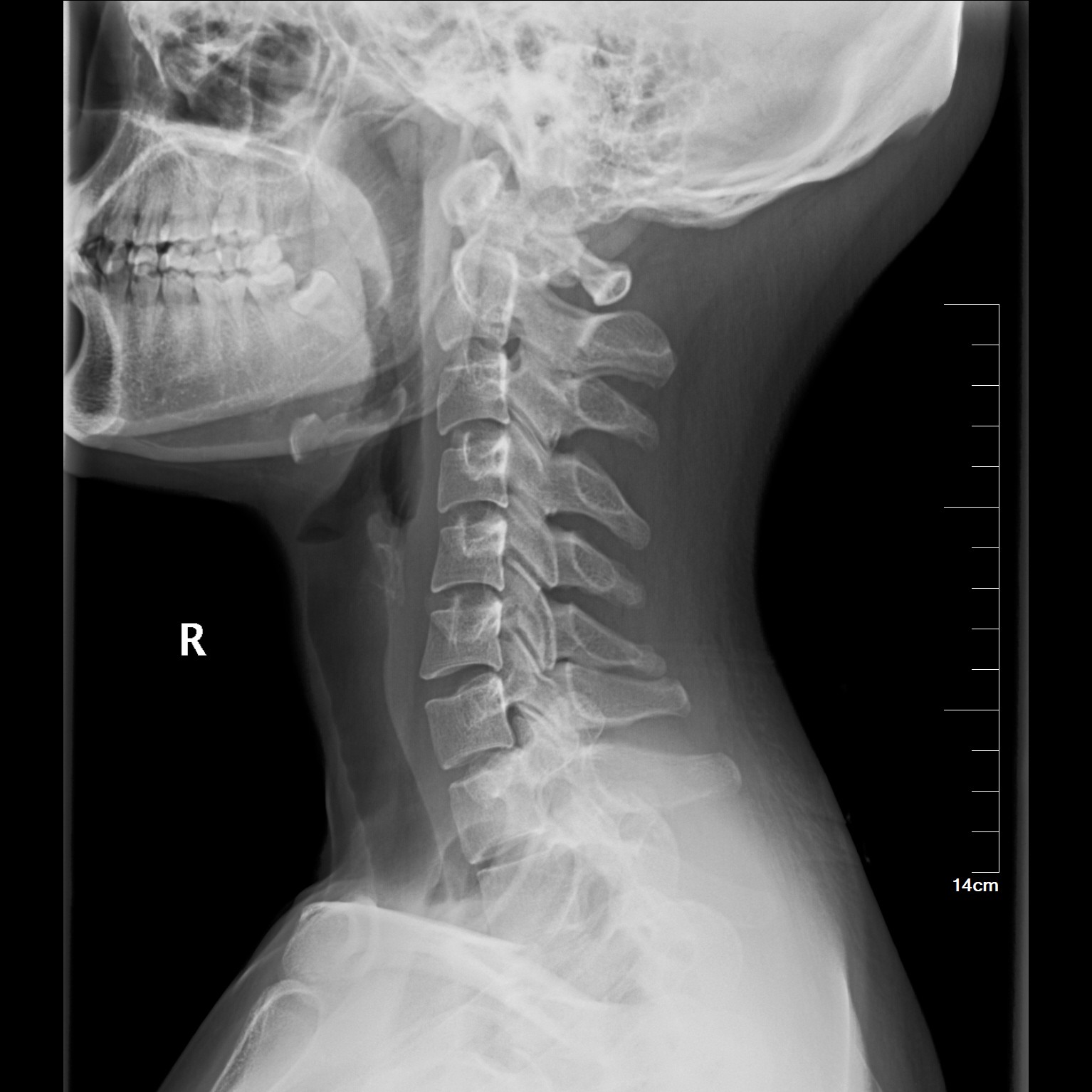 Foreign Objects X-Ray