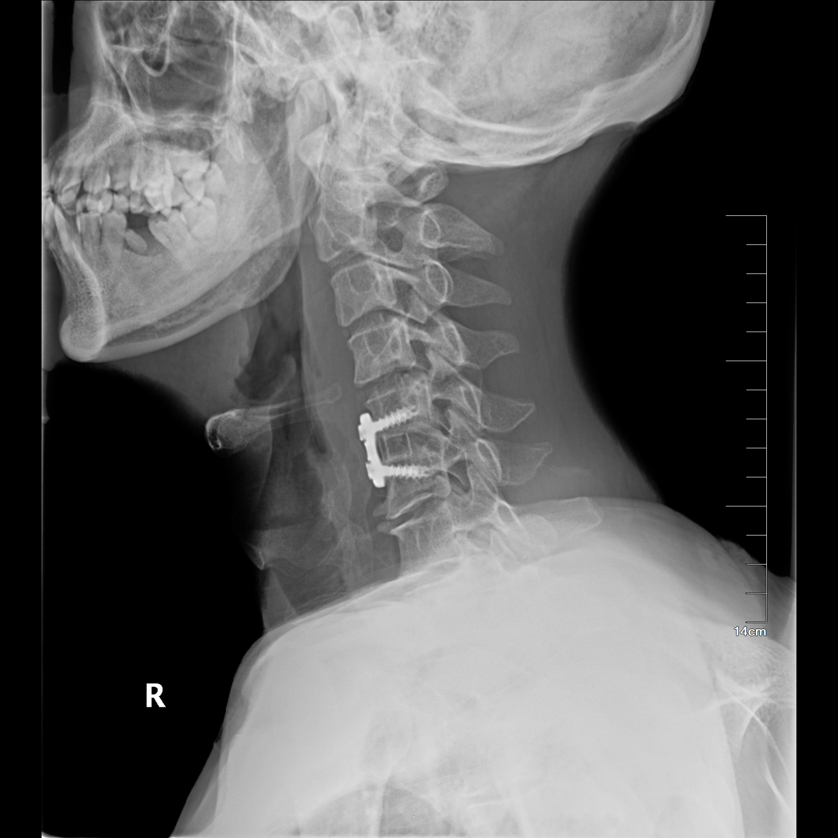 Biomedical Foreign Object