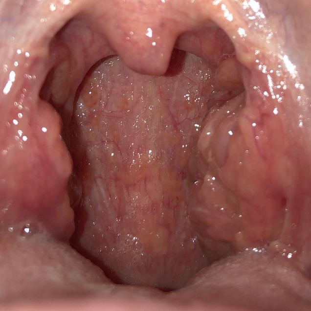 Moderate Pharyngitis