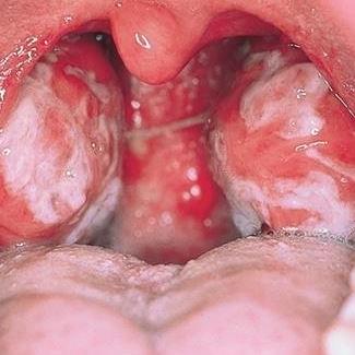 Tonsil Pharyngitis