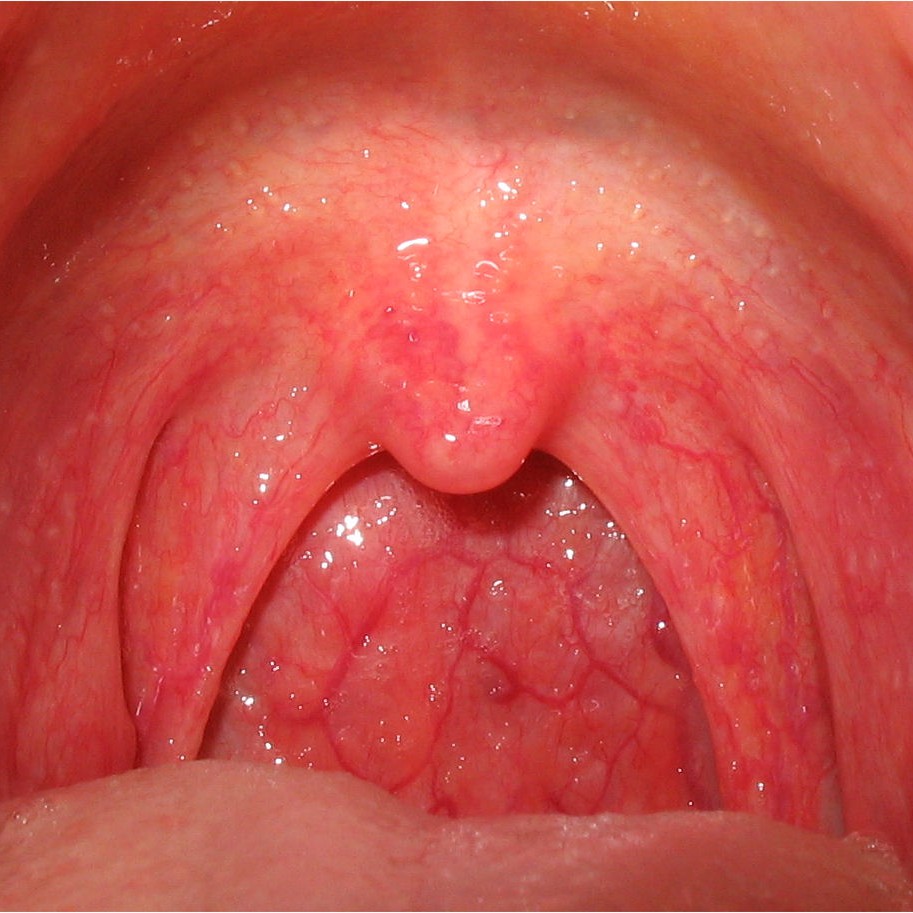 Pharyngitis Image
