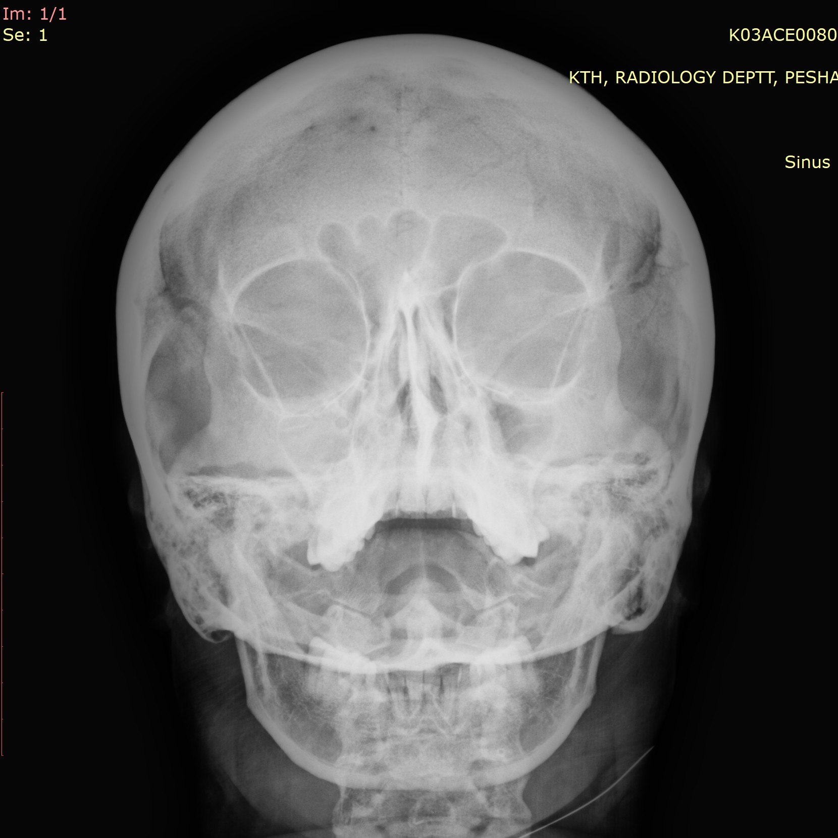 Severe Sinusitis