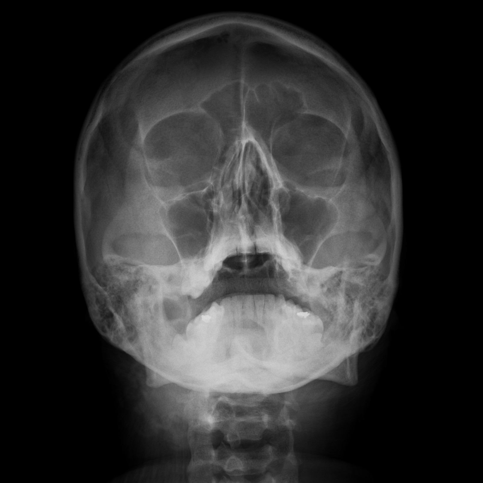 Mild Sinusitis
